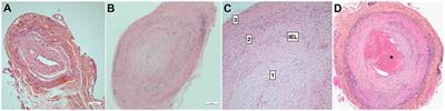 Giant-cell arteritis related strokes: scoping review of mechanisms and rethinking treatment strategy?